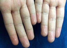 Abnorm svedproduktion (Hyperhidrosis)