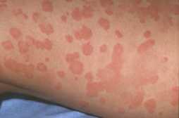 Akut hudinfektion røde pletter på huden [Erythema multiforme]