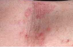 Børneeksem [atopisk dermatit] i albuebøjning
