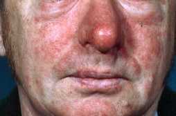 Allergisk kontakteksem (dermatitis contactus allergica)