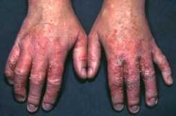 Toksisk kontakteksem (dermatitis contactus toxica)