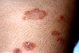 Væskefyldte blærer [dermatitis herpetiformis]