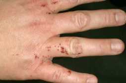 Fnat [Scabies]
