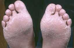 Fodeksem [Dermatit plantaris sicca]