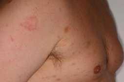 Fransk rosen. Pityriasis rosea