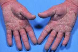 Håndeksem [Eczema keratoticum]