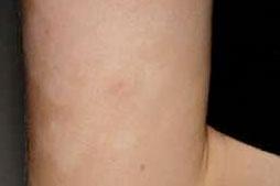 Hudforandringer, blege [pityriasis alba]
