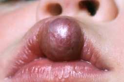 Hudtumorer (cancer)