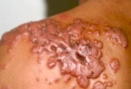 Fortykket ardannelse (keloid)