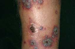 Karbetændelse. Vasculitis