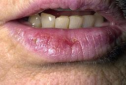 Læbebetændelse. cheilitis