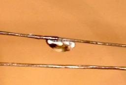 Lus (Pediculosis)