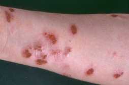 Mønteksem [Eczema nummulatum]