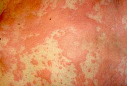 Nældefeber. Urticaria.