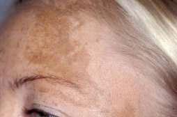 Pigmentforandringer. Melasma. Chloasma