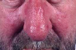 Portvinstud [rhinophyma]