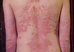 Almindelig psoriasis (psoriasis vulgaris): rød, skællende plet på huden