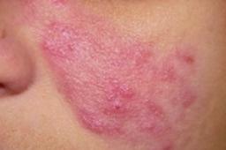 Rødme i huden i ansigtet. Rosacea