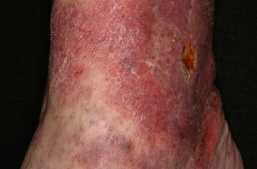 Staseeksem på skinneben [eczema cruris hypostaticum]