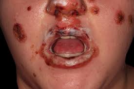 Stevens-Johnsons syndrom [erythema multiforme]