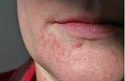 Udslæt omkring munden [Dermatit perioralis]