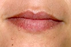 Vandvorter (Molluscum contagiosum)