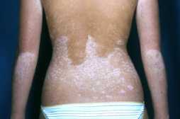 Vitiligo. hudpletter, lyse, uregelmæssige
