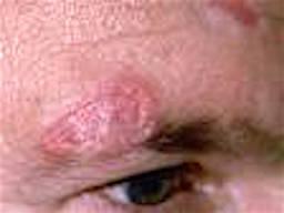 Hudsygdom på ansigt. lupus erytematosus