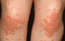 Gianotti-Crostis syndrom [dermatitis papulosa infantum]